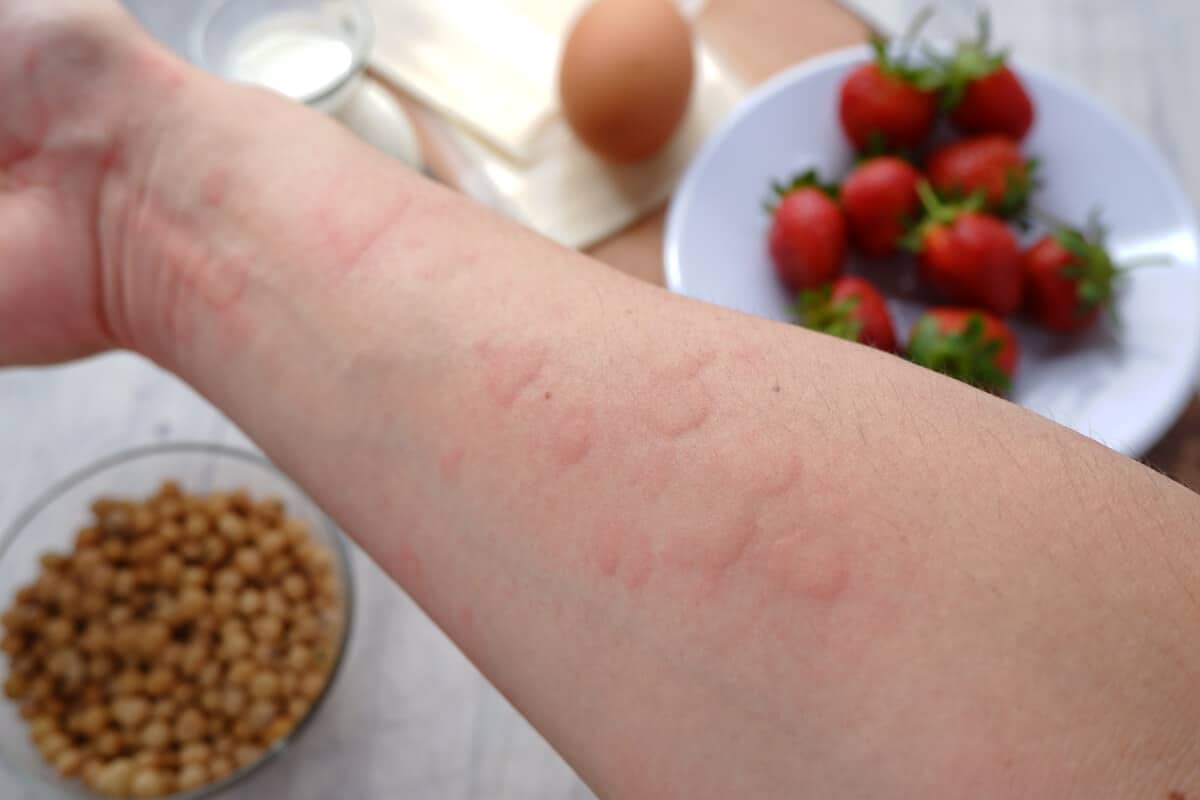 food sensitivity tests