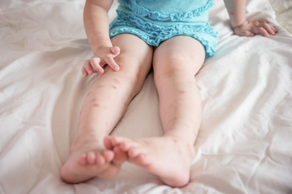 natural bug bite relief cover image